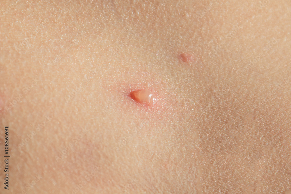 Chicken pox on child skin Chicken pox on child skin