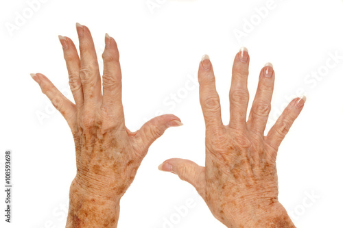 Medical: Female senior citizen hand with Rheumatoid Arthritis and age spots (also known as liver spots, Solar lentigo, Lentigo senilis and Senile freckle) shot on a white background photo