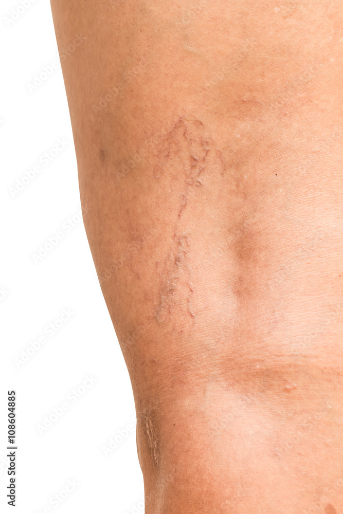 Varicose veins on the legs of middle-aged women. Varicose veins on the legs of middle-aged women.
