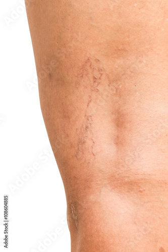Varicose veins on the legs of middle-aged women.