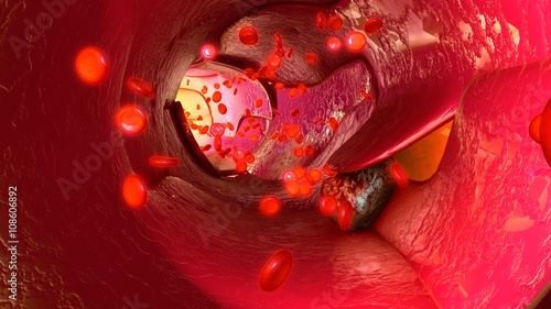 Bilde på lerret Tumour cells in blood vessels