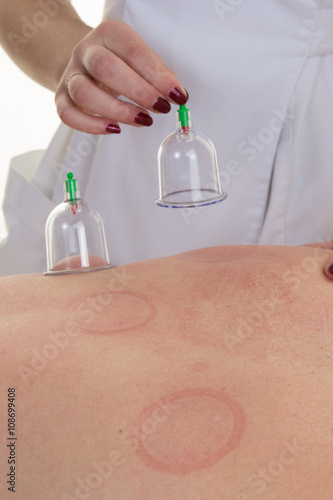 Chinese medicine cupping of the man's back photo