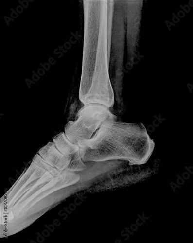 Human foot ankel and leg xray picture.