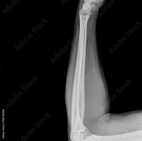 X-ray view of elbow on a black background