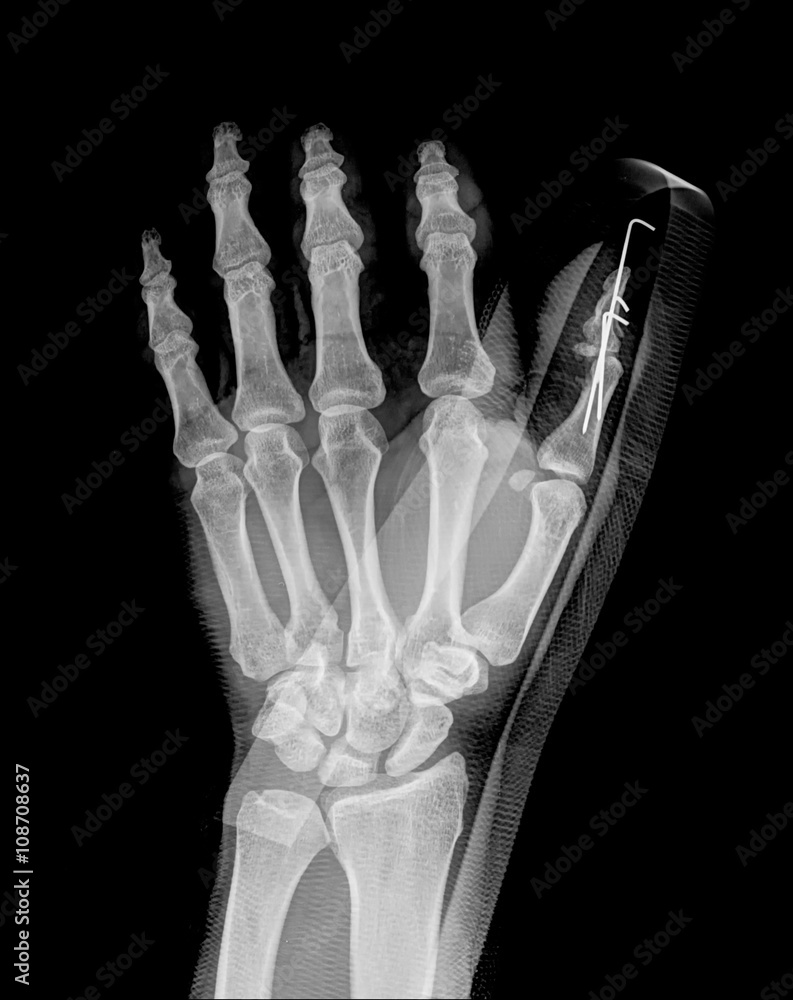 Broken hand after external fixation on roentgenogram Broken hand after external fixation on roentgenogram
