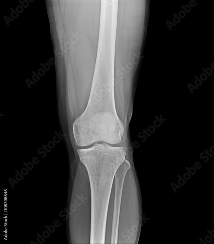 Right knee joint X-ray photos, the front position