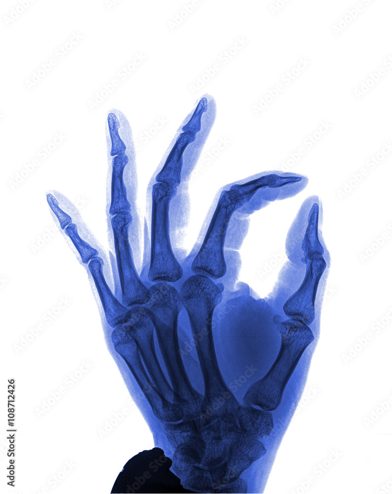 Human hand x-ray - Medical Image. Human hand x-ray - Medical Image.
