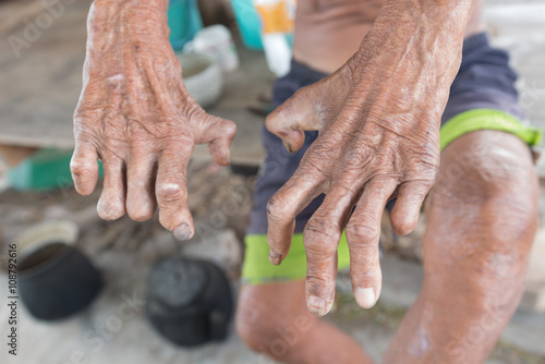 Fototapeta Hansen's disease,closeup hands of old man suffering from leprosy