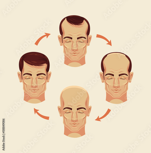 Stages of baldness. Vector flat cartoon illustration