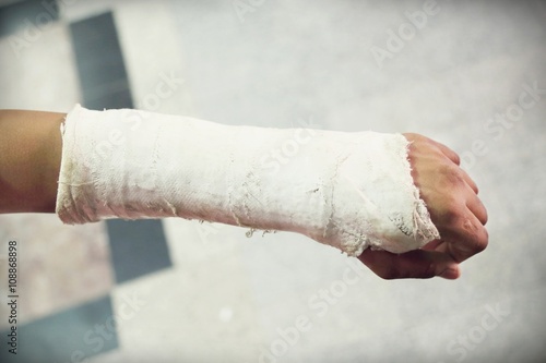arm splint, be in plaster cast