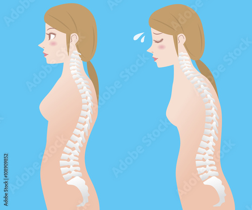 Good posture and bad posture, woman's body silhouette and backbone, chiropractic before after image, vector illustration