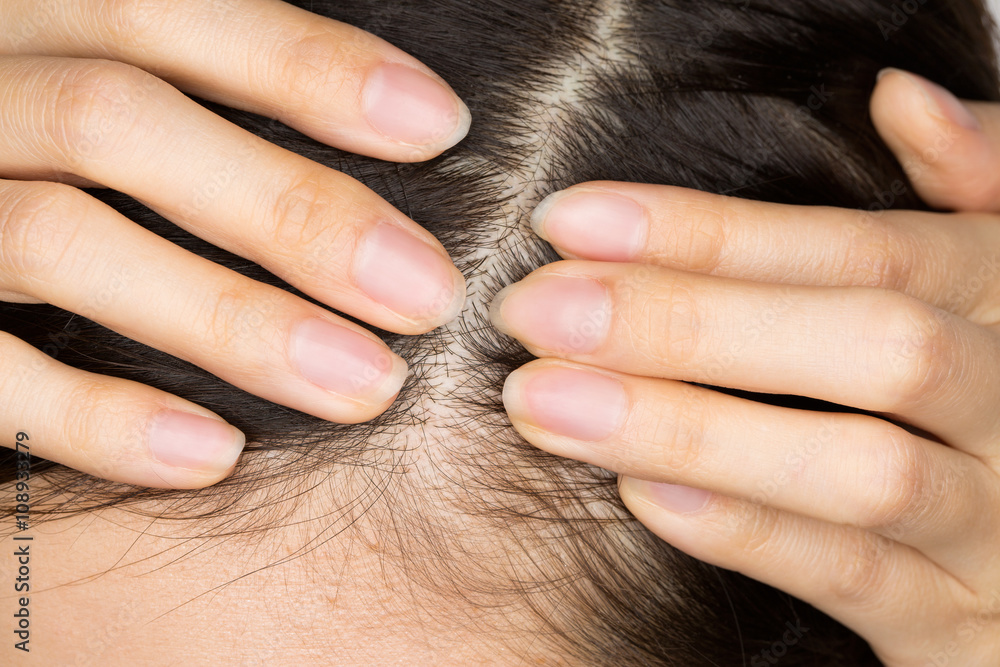 Fototapeta premium 頭皮のクローズアップ / 若い女性