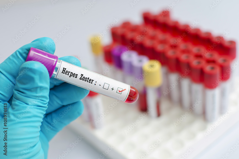 Blood sample positive with herpes zoster test Stock Photo Adobe Stock