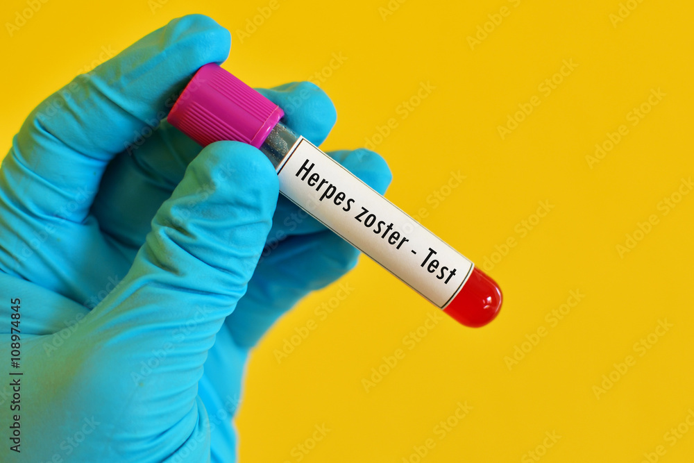 Fototapeta premium Blood sample for herpes zoster test 