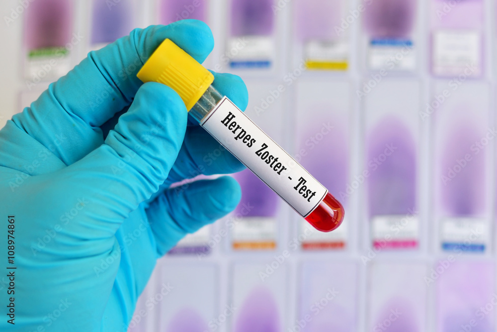 Blood sample for herpes zoster test
Blood sample for herpes zoster test