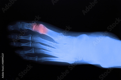 X-ray of foot