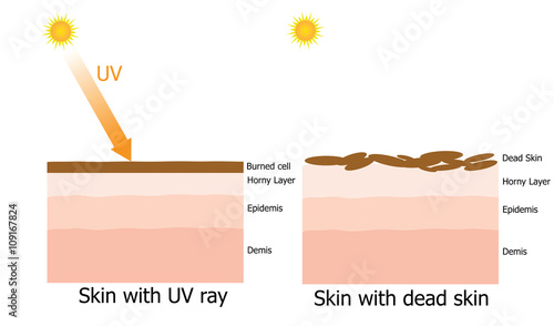 Infographic about dead skin on human skin by UV ray