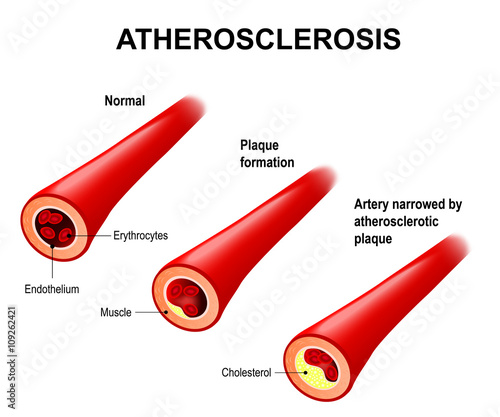 Illustrates the progression of atherosclerosis in CVD patients.