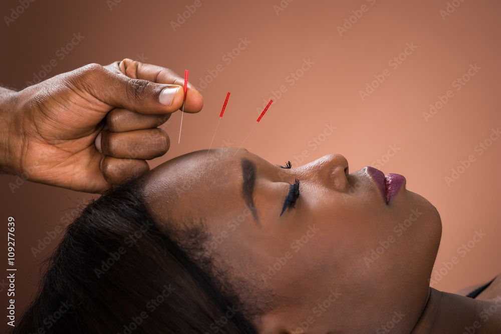 Young Woman Getting Acupuncture Treatment - obrazy, fototapety, plakaty 
