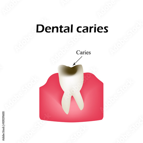 Deep tooth decay. Vector illustration on isolated background
