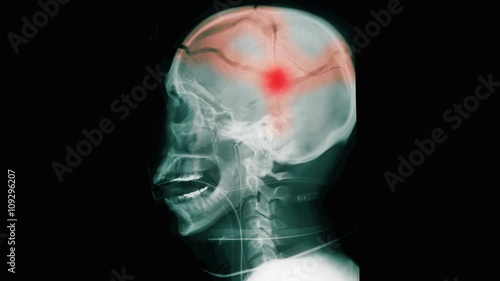 Bullet in skull