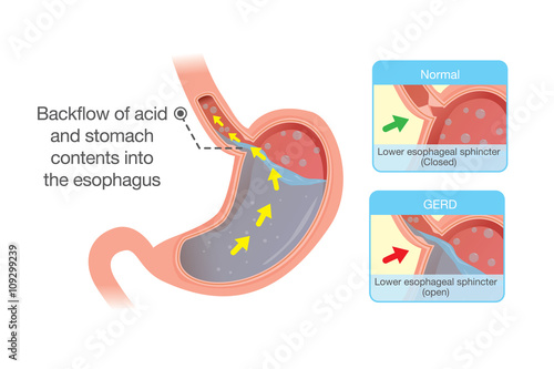Medical illustration about acid in stomach back up into esophagus which is cause gastroesophageal reflux disease. Medical illustration.