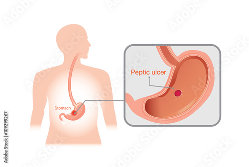 Closeup picture of peptic ulcer or sores in the lining of the human stomach.
