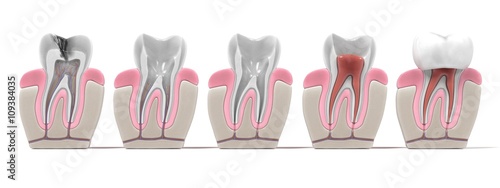 3d renderings of endodontics - root canal procedure