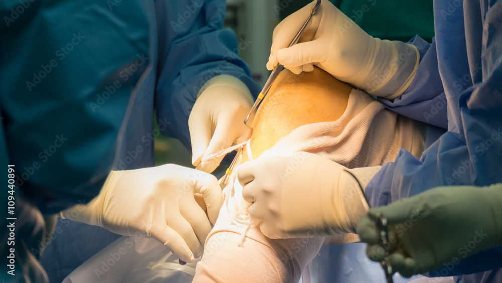 Preparation tendon For ACLR (Arthroscopic ACL reconstruction) Preparation tendon For ACLR (Arthroscopic ACL reconstruction)