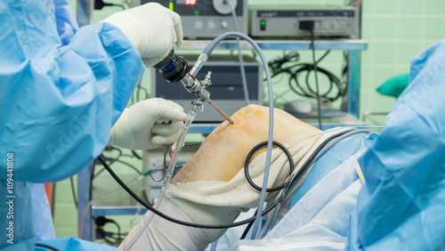 Arthroscopic ACL reconstruction