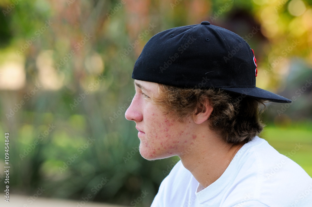 Teenage boy with acne and backwards baseball hat looking sideway Stock  Photo | Adobe Stock