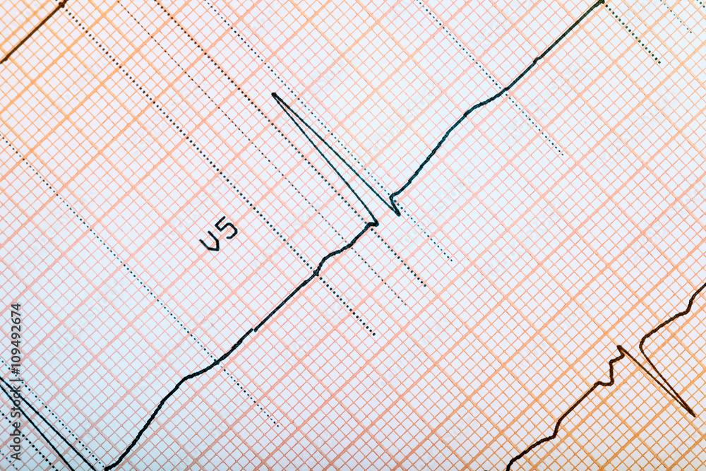 ECG monitoring of patient ECG monitoring of patient