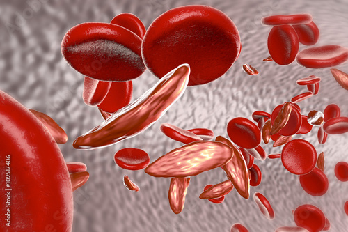 Sickle cell anemia, 3D illustration showing blood vessel with normal and deformated crescent-like red blood cells photo
