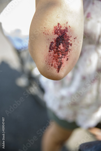 Cropped view of girls arm with grazed elbow, focus on foreground