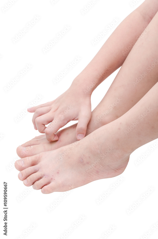 Leg with sore from scratching over white background Leg with sore from scratching over white background