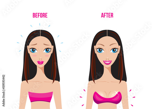 Before and After breast augmentation with silicon implants Happy woman