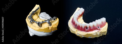 Proceso Prótesis completa sobre implantes 
