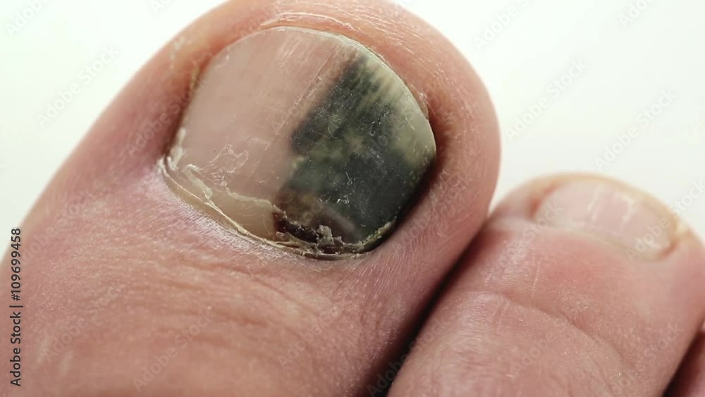 Trauma of toenail. Subungual hematoma. Bruise under the nail of big toe. Injury to the nail. Sick nail. Sickly, diseased, unhealthy nail Trauma of toenail. Subungual hematoma. Bruise under the nail of big toe. Injury to the nail. Sick nail. Sickly, diseased, unhealthy nail