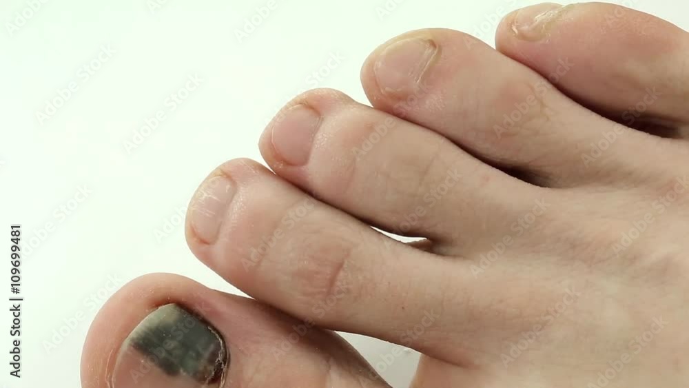 Wideo Stock Subungual hematoma. Bruise under the nail of big toe