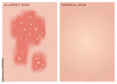 allergy skin texture and healthy skin texture