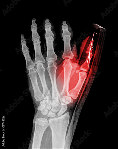 Fotografie Broken hand after external fixation on roentgenogram , thumb pain