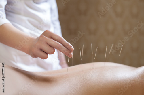 needle acupuncture procedure; photo
