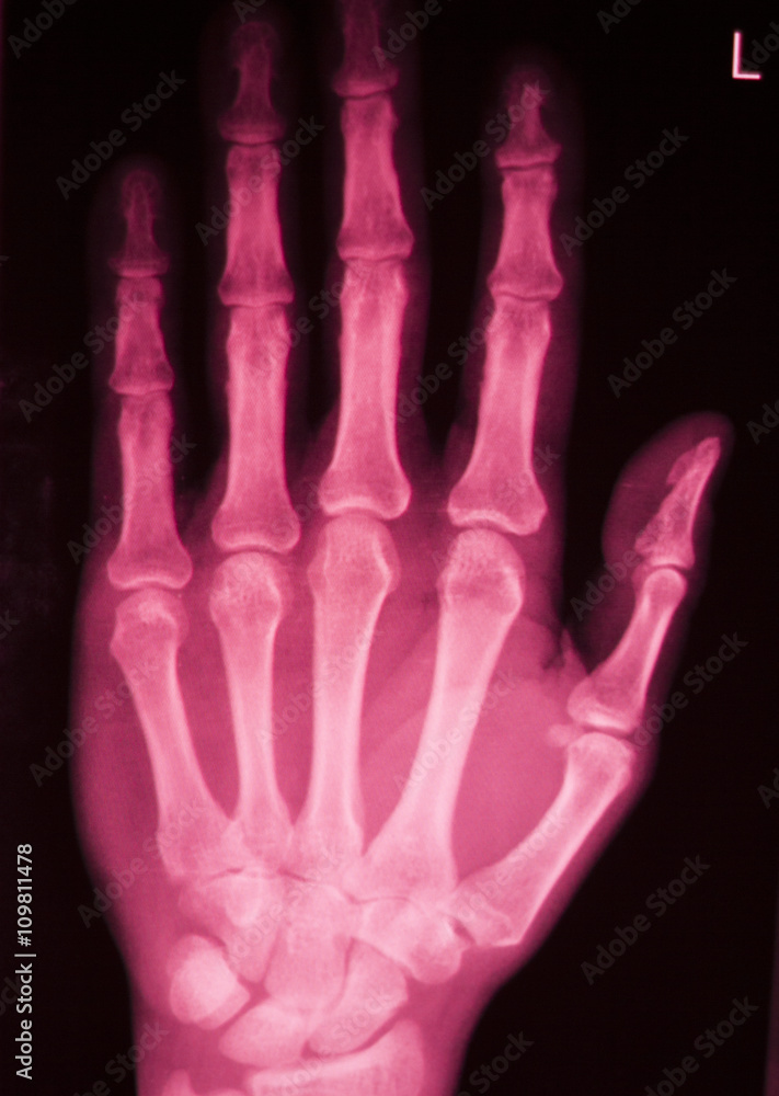 Hand and finger injury xray scan Hand and finger injury xray scan