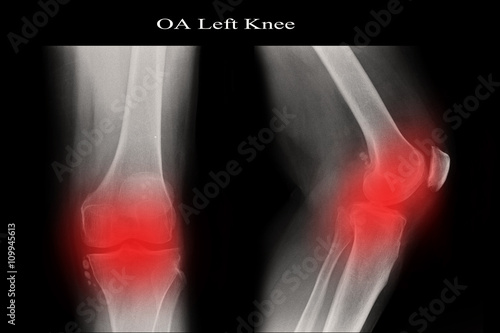 OA Left Knee
