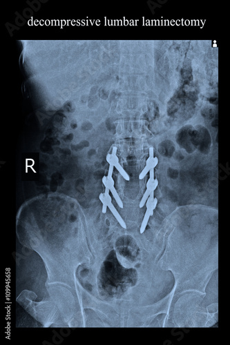 lumbar larminectomy