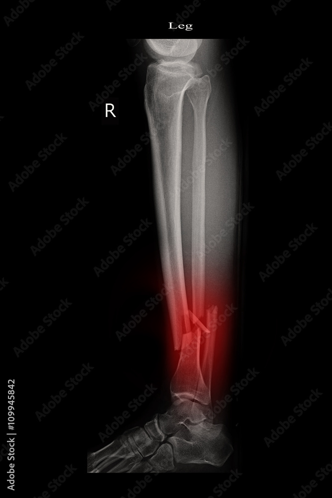 fracture left leg tibia and fibula Stock Photo | Adobe Stock