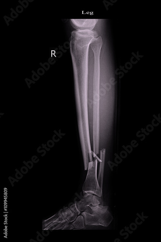 fracture left leg tibia and fibula