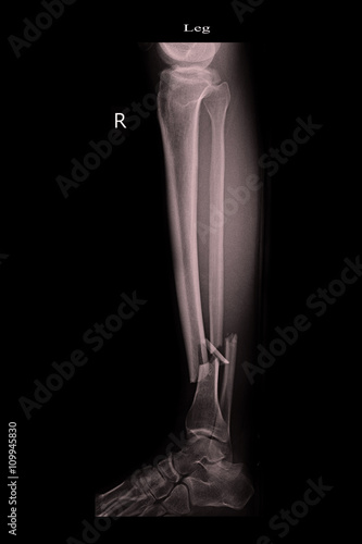 fracture left leg tibia and fibula