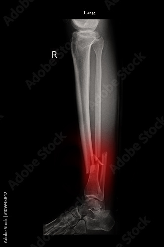fracture left leg tibia and fibula