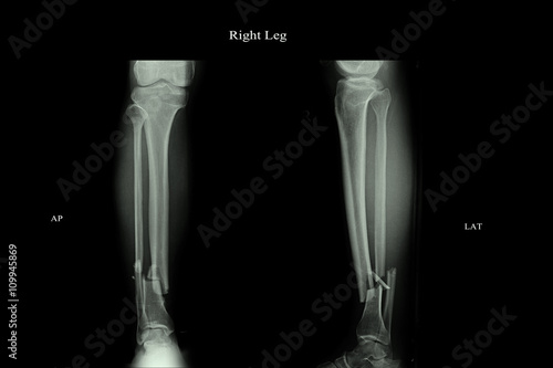 closed fracture left leg tibia and fibula